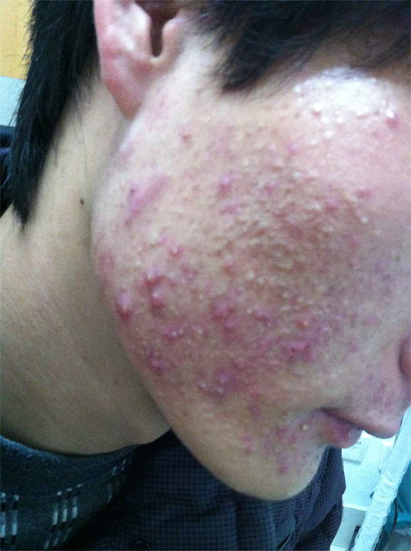 青春痘怎么护理方法